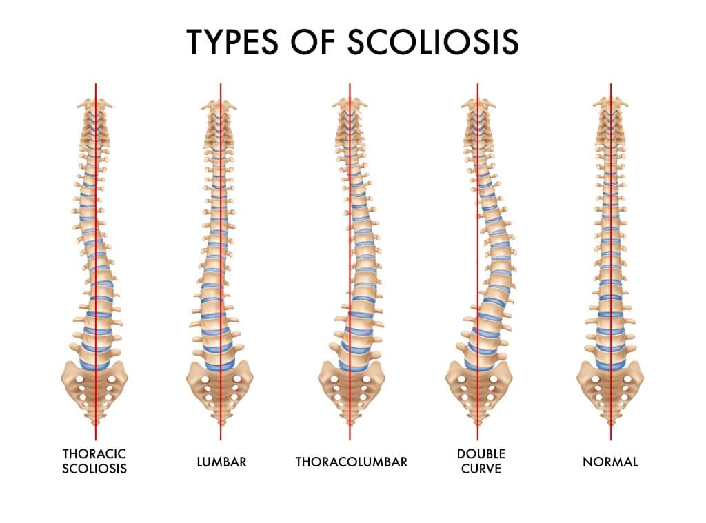 Understanding and Managing Scoliosis: A Comprehensive Guide Understanding and Managing Scoliosis: A Comprehensive Guide