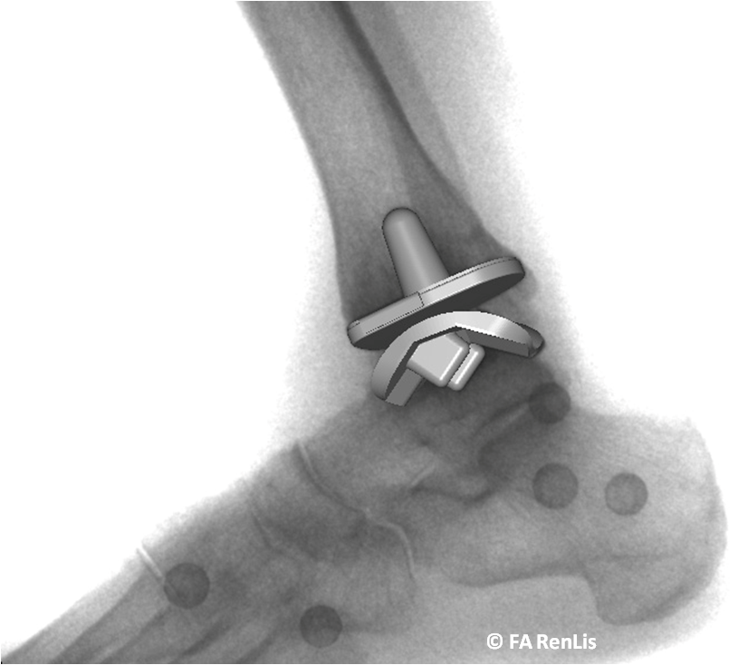 And x-ray of an ankle post replacement