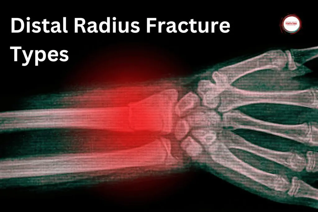 Distal Radius Fracture Types