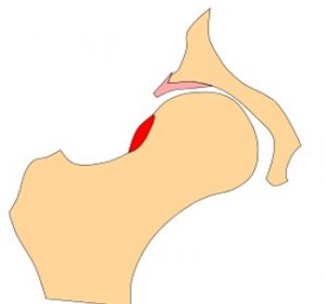 A picture showing hip impingement