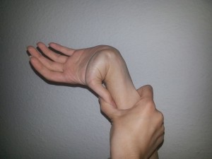 A picture of a hypermobile jointed hand