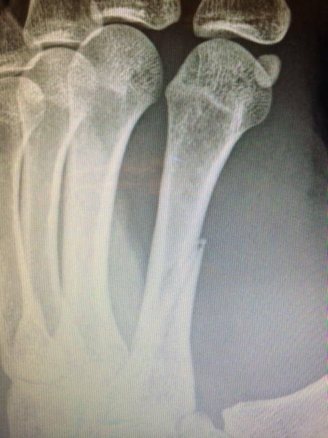 A picture of a hand fracture, Vic Frosdick, Central Health Physiotherapy