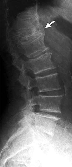 Xray showing consequences of osteoporosis