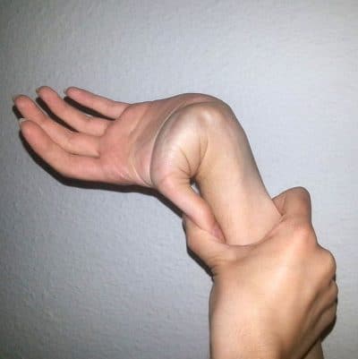 hypermobile joint