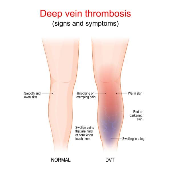 what is DVT? Signs and symptoms of DVT  with visual representation.