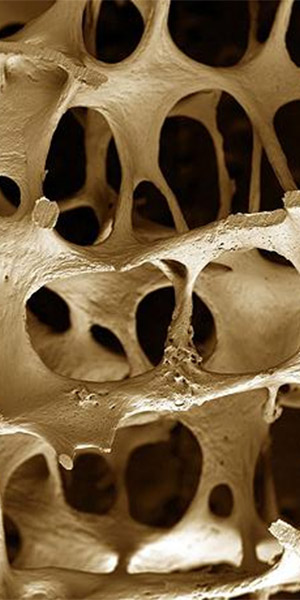 Skeleton Osteoporosis